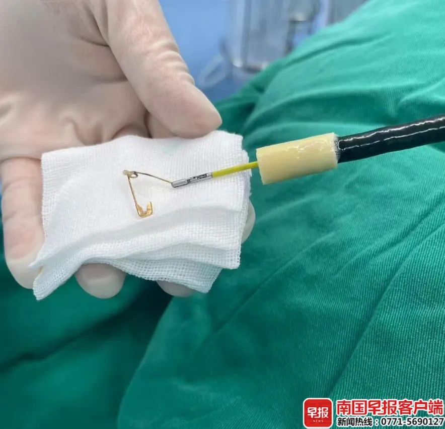 广西7个月宝宝反复咳嗽发烧，医生一查：食管里卡着一枚尖锐别针！