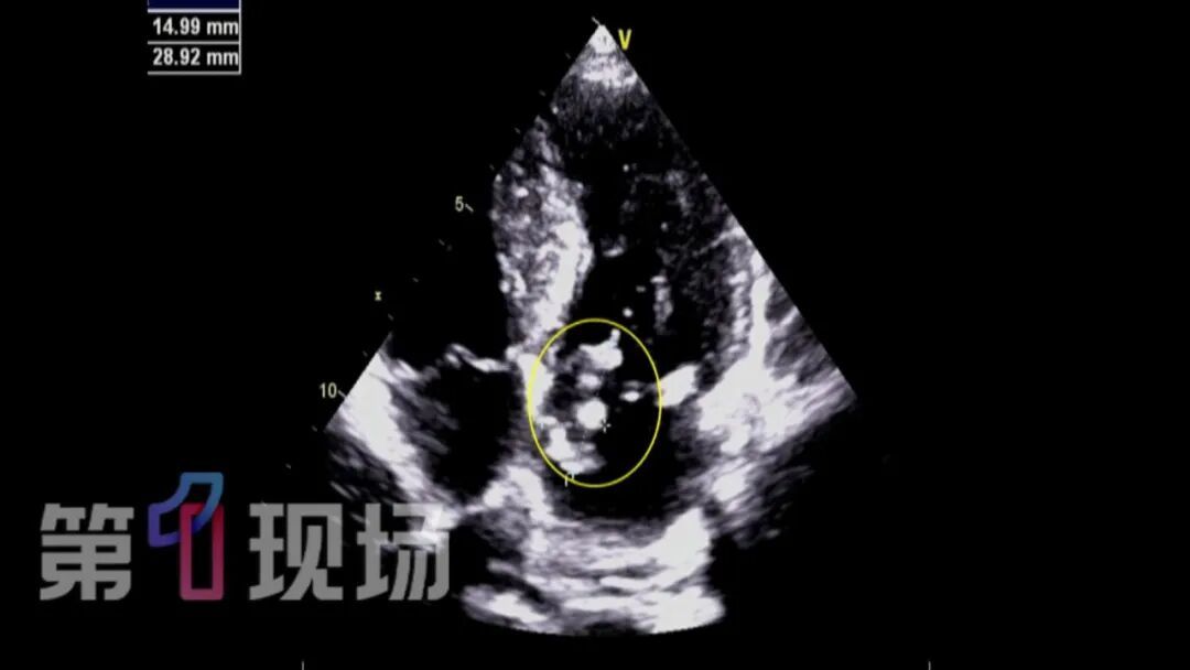 深圳51岁男子心脏长了“马蜂窝”，每天给脑子、肾脏释放细菌团！医生：病根来自口腔