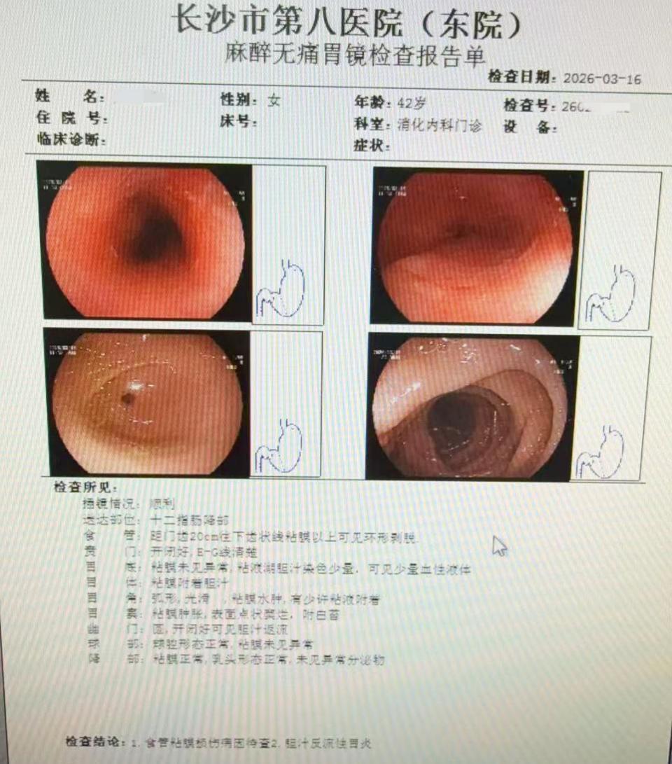 吃火锅专注聊天，女子将滚烫食物吞下肚，烫出8厘米食管溃疡