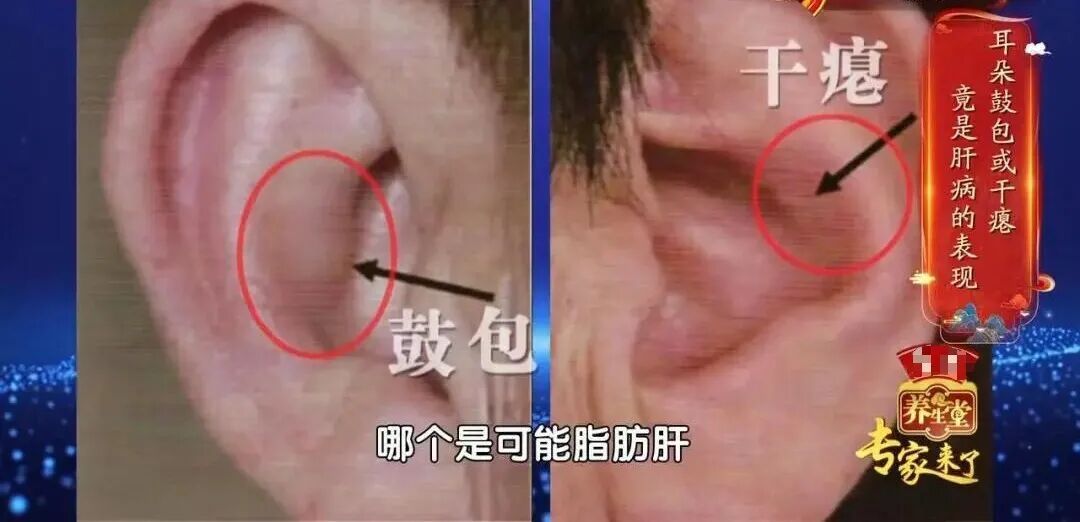 肝好不好，看看耳朵就知道，揉开这3个地方，疏肝气、养肝阴