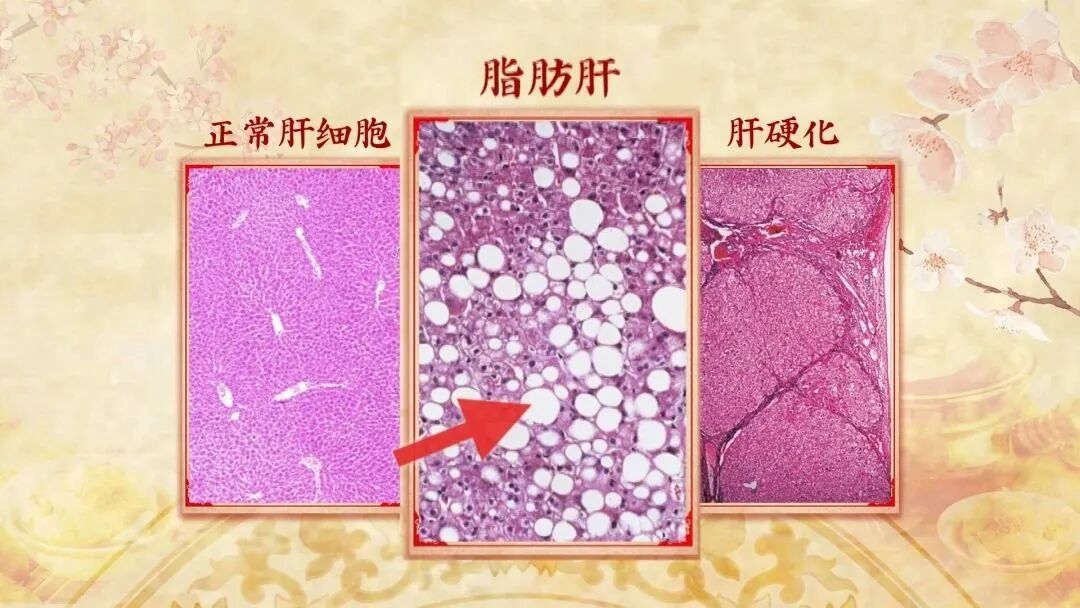 肝好不好，看看耳朵就知道，揉开这3个地方，疏肝气、养肝阴