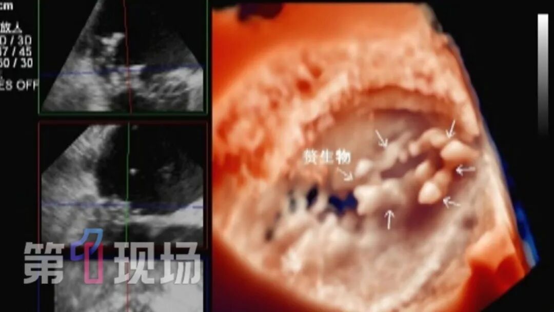 赶紧自查！男子心脏长出巨型“马蜂窝”！这种病太常见，很多人不当回事！