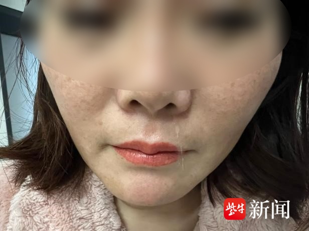 女子“鼻炎”6年治不好,一查竟是脑子“漏水”了 女子“鼻炎”6年治不好,一查竟是脑子“漏水”了