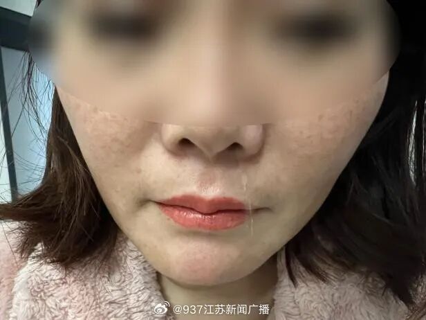 江苏一女子流了6年“鼻涕”，发现竟是脑子“漏水”！