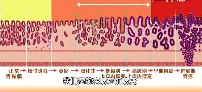 这样打嗝，可能是胃癌找上门！有人一发现就是晚期！