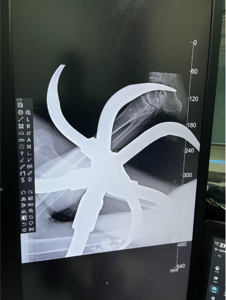 57岁男子大腿被犁头贯穿致失血性休克！看郴州医生如何从“铁牛”嘴里抢回一条命