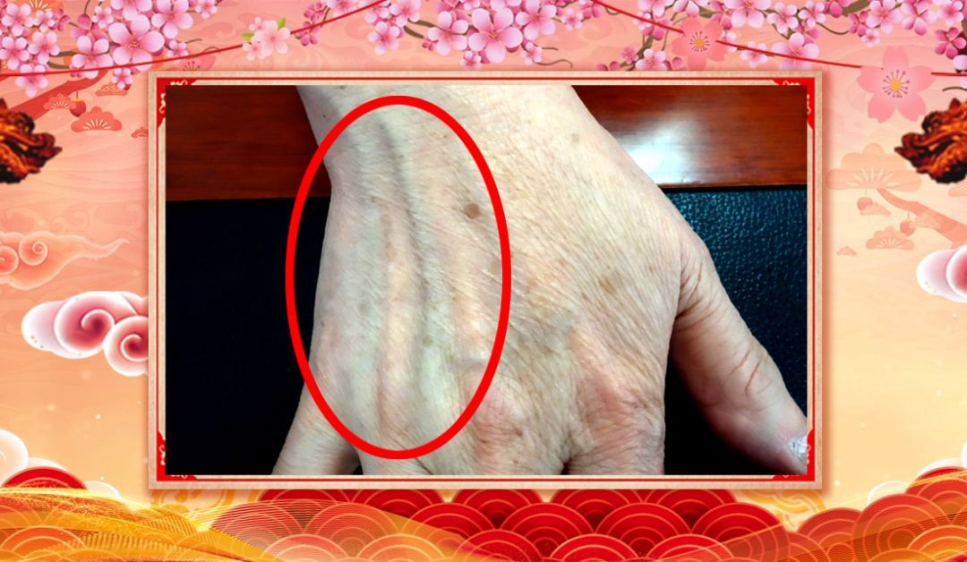 手上有这个表现，多半是心脏不好，2个实用小方，帮你降脂、祛火、护血管