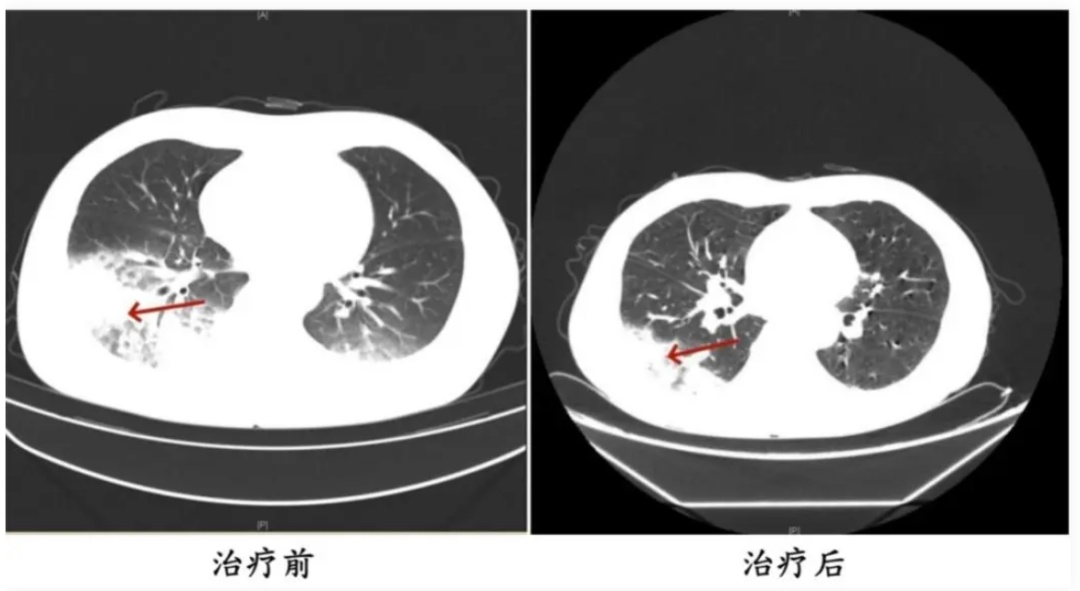 左肺大面积感染！男子连续3天高烧干咳！提醒：夏天首次开空调，千万不要先开制冷！