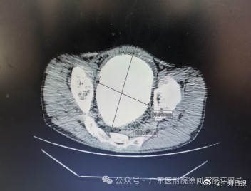 男子忍痛3年膀胱取出2.6斤巨型结石 男子忍痛3年膀胱取出2.6斤巨型结石