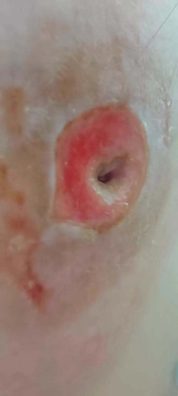 为治一颗痘,浙江女子2个月狂涂几十种药膏,烂出“黑洞”毁了半张脸,或永久毁容 为治一颗痘,浙江女子2个月狂涂几十种药膏,烂出“黑洞”毁了半张脸,或永久毁容