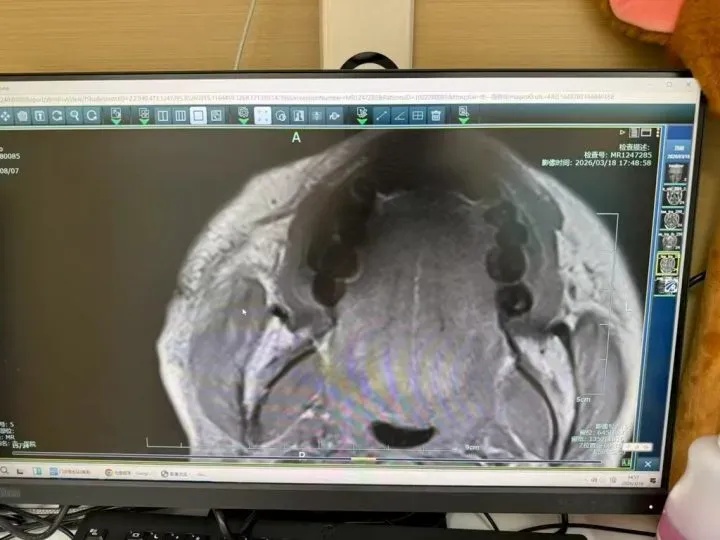 为治一颗痘,浙江女子2个月狂涂几十种药膏,烂出“黑洞”毁了半张脸,或永久毁容 为治一颗痘,浙江女子2个月狂涂几十种药膏,烂出“黑洞”毁了半张脸,或永久毁容
