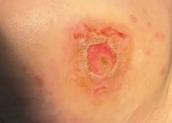 为治一颗痘,浙江女子2个月狂涂几十种药膏,烂出“黑洞”毁了半张脸,或永久毁容 为治一颗痘,浙江女子2个月狂涂几十种药膏,烂出“黑洞”毁了半张脸,或永久毁容