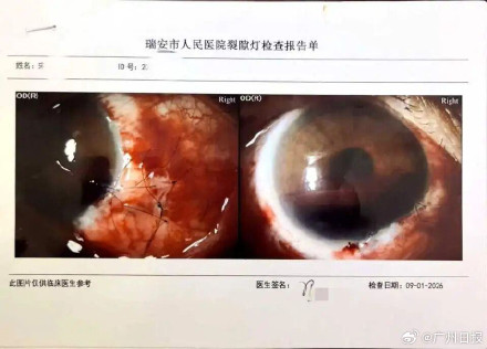 校方通报教师被学生用镊子戳伤眼球 校方通报教师被学生用镊子戳伤眼球