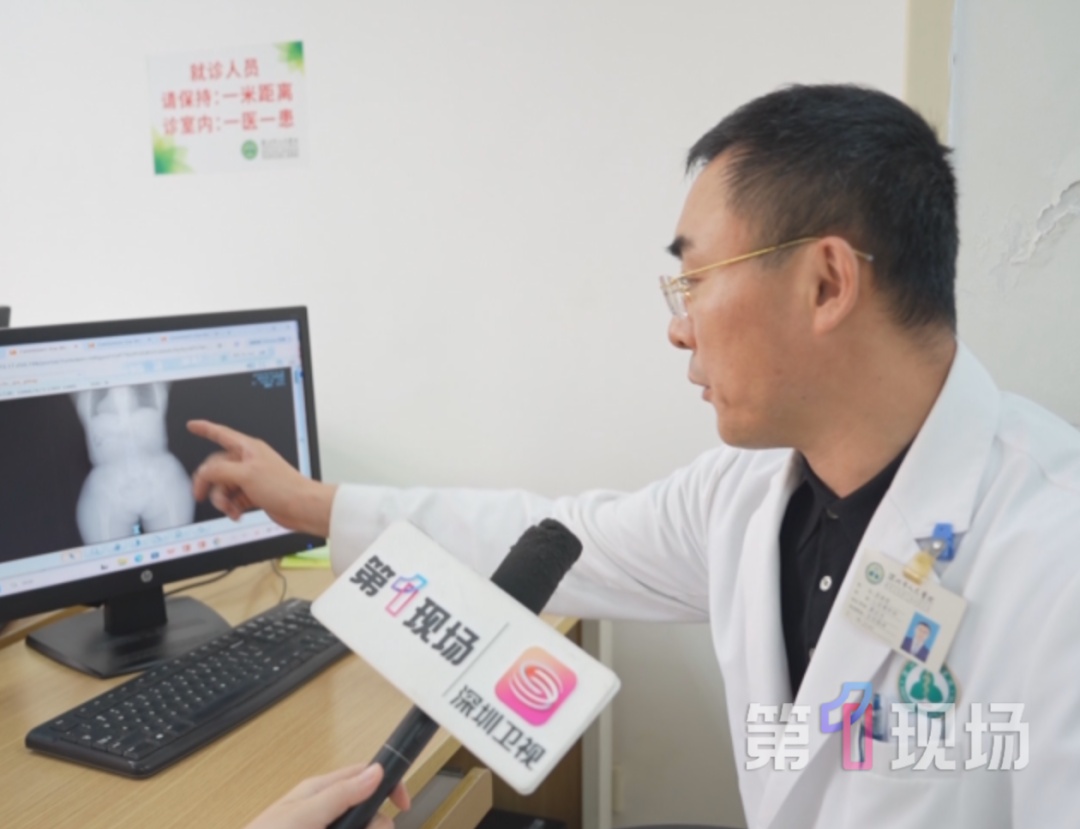 国内首例！深圳医生成功为“镜面人”修复“反位心脏”瓣膜