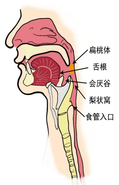 鱼刺卡喉如何自救？正确做法看这里→
