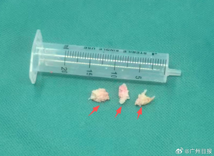 男子肩痛自行使用按摩仪后瘫痪 男子肩痛自行使用按摩仪后瘫痪