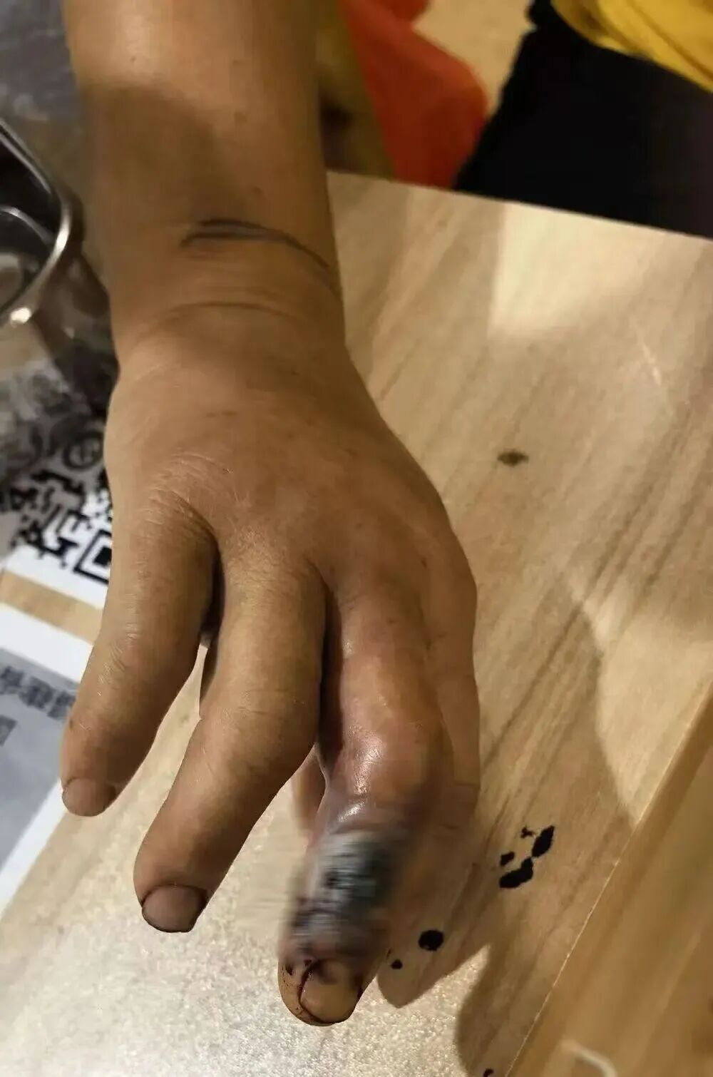 女子被2米长眼镜蛇咬,单手生擒毒蛇到医院就医,被咬手指发黑溃烂! 女子被2米长眼镜蛇咬,单手生擒毒蛇到医院就医,被咬手指发黑溃烂!