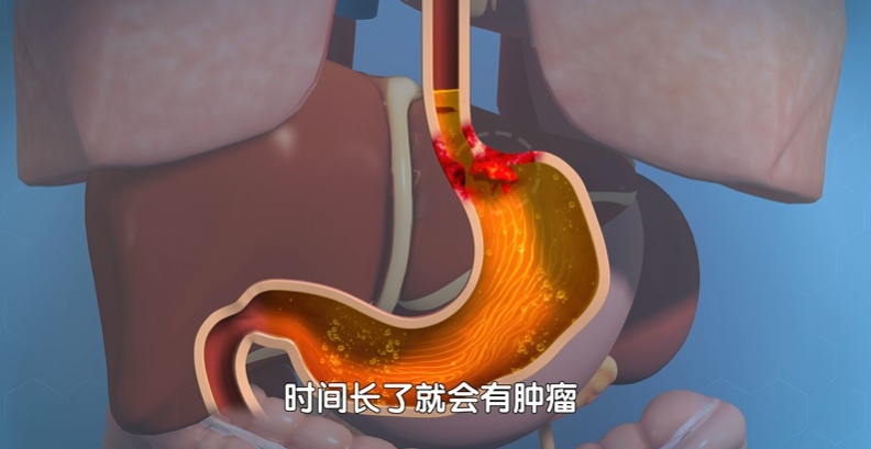 炎症会在体内留下“癌变种子”？多吃这些“抗炎食物”，远离癌症危机