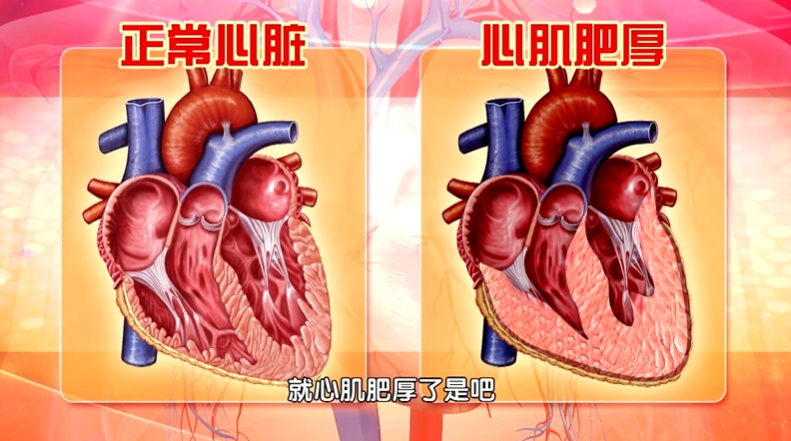 马上停止5类运动,很可能加速血栓形成,等血管“堵死”就迟了 马上停止5类运动,很可能加速血栓形成,等血管“堵死”就迟了