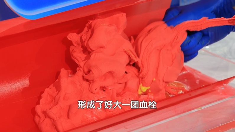 马上停止5类运动,很可能加速血栓形成,等血管“堵死”就迟了 马上停止5类运动,很可能加速血栓形成,等血管“堵死”就迟了