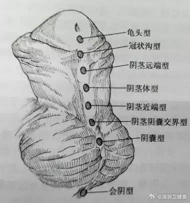 男子从小蹲着尿，发现无法行房后紧急求医！医生：每300个男孩就有1个中招
