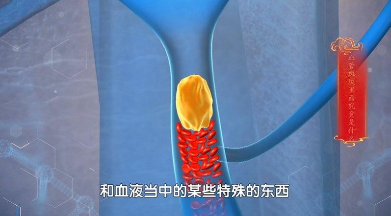 马上停止5类运动,很可能加速血栓形成,等血管“堵死”就迟了 马上停止5类运动,很可能加速血栓形成,等血管“堵死”就迟了