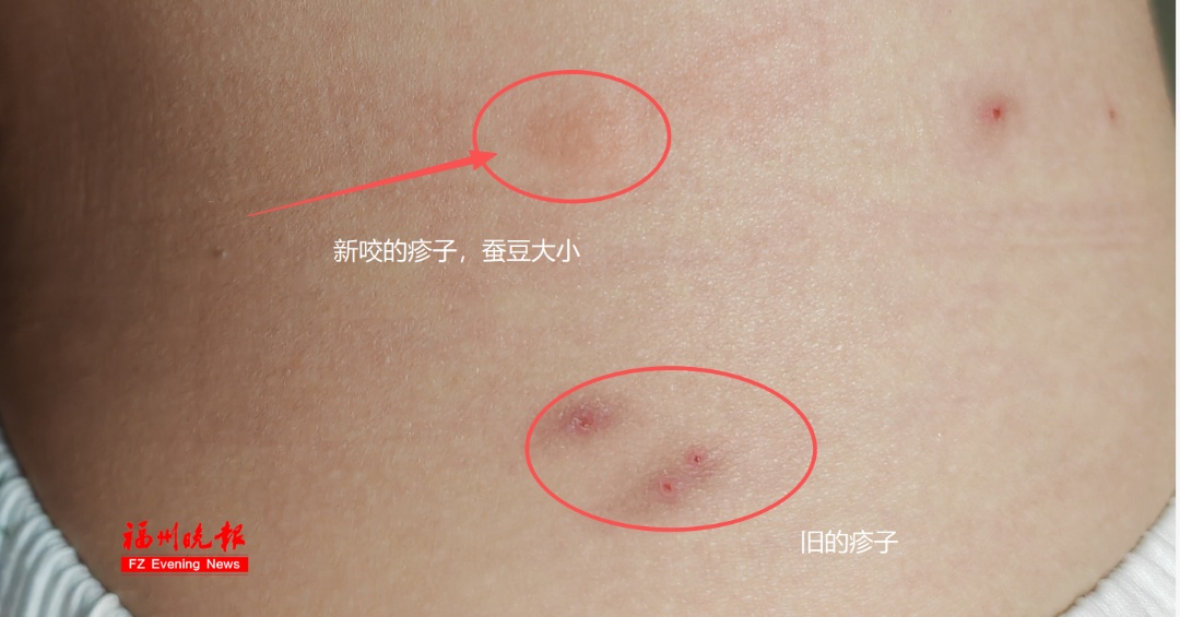 太痒了，已有人中招！福州医生提醒