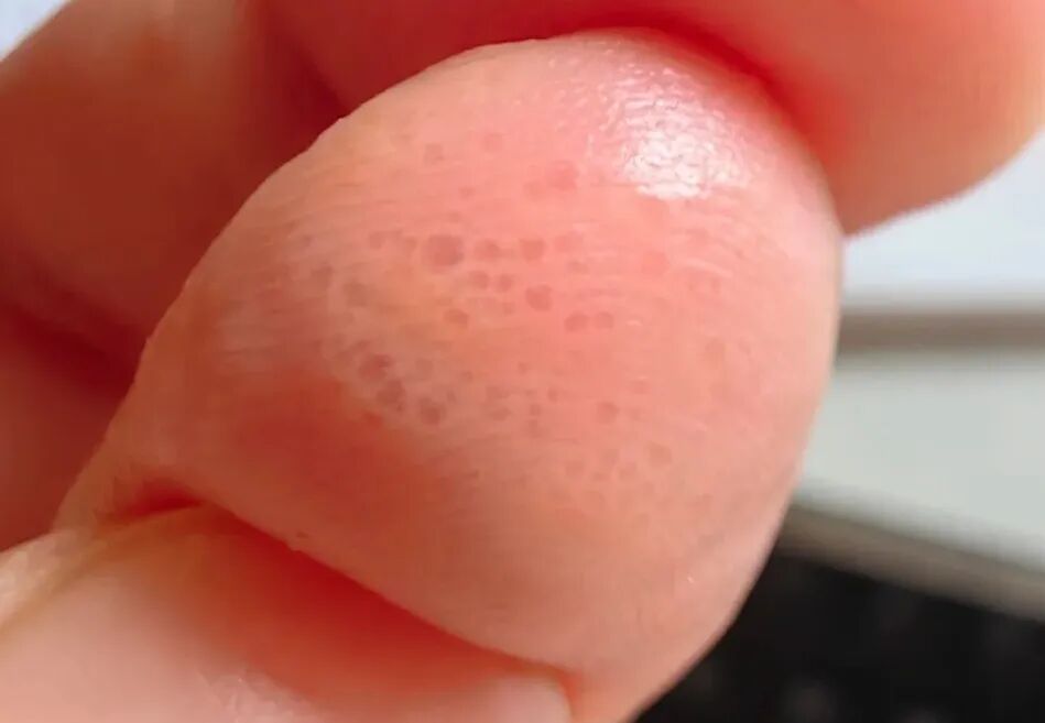 这种夏天手上爱长的小水疱，到底是什么？（附应对方法）