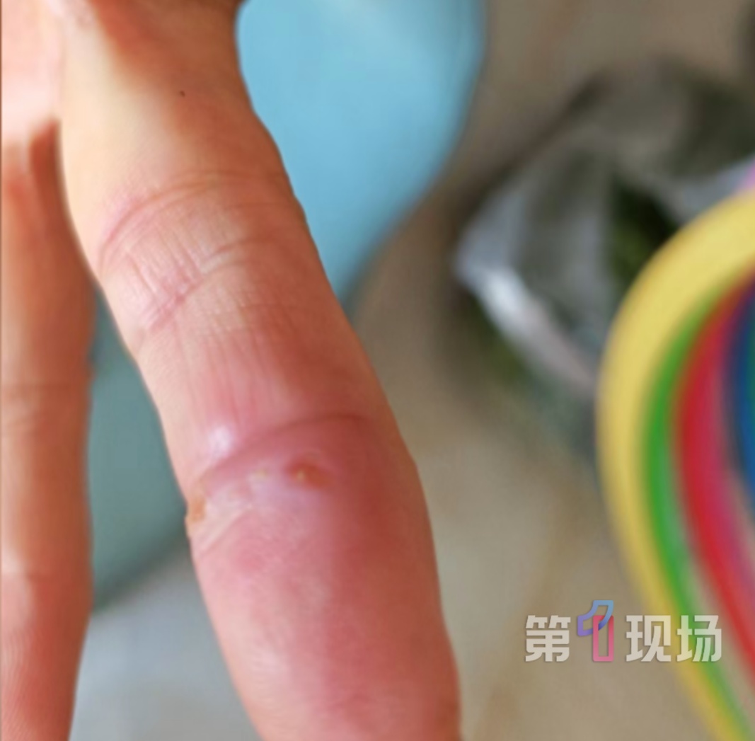 女子洗龙虾被扎伤，20天后手指肿成紫红色，多处淋巴结肿大