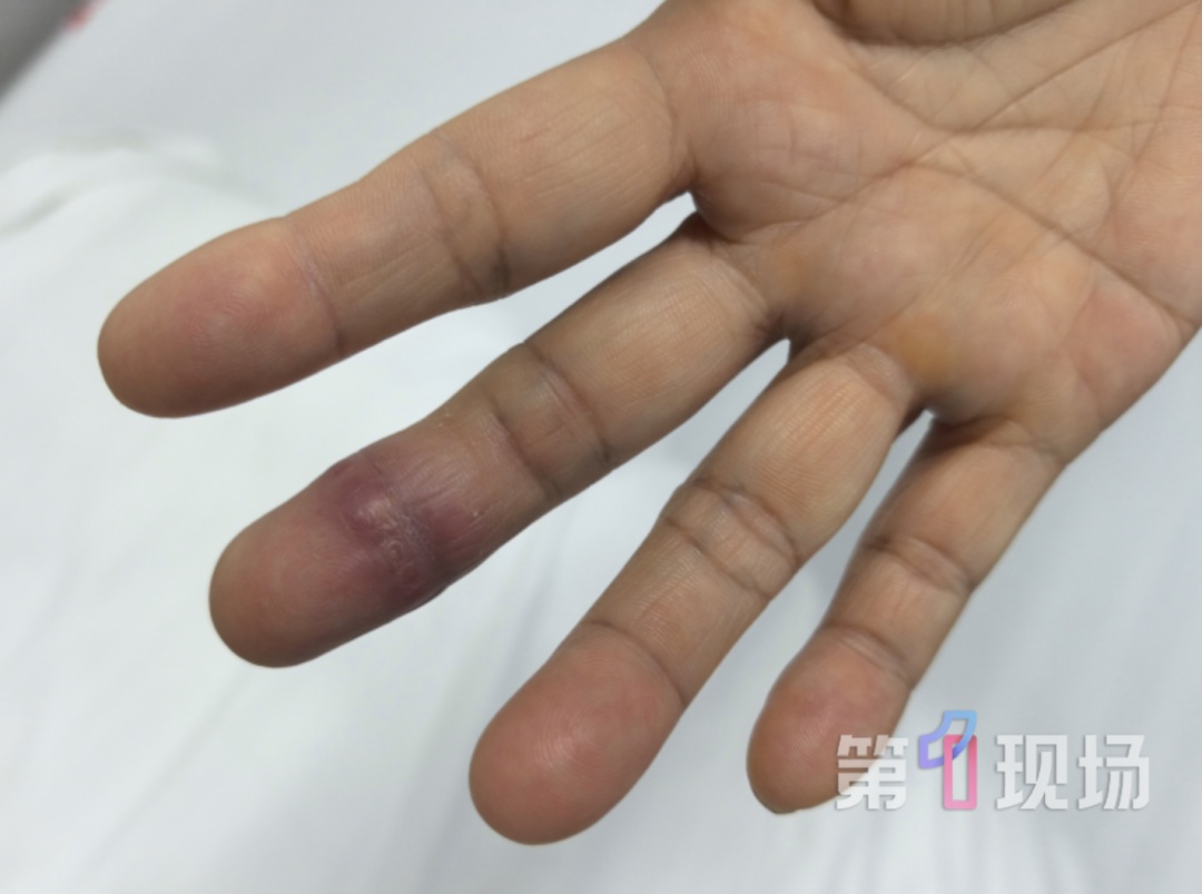 女子洗龙虾被扎伤，20天后手指肿成紫红色，多处淋巴结肿大