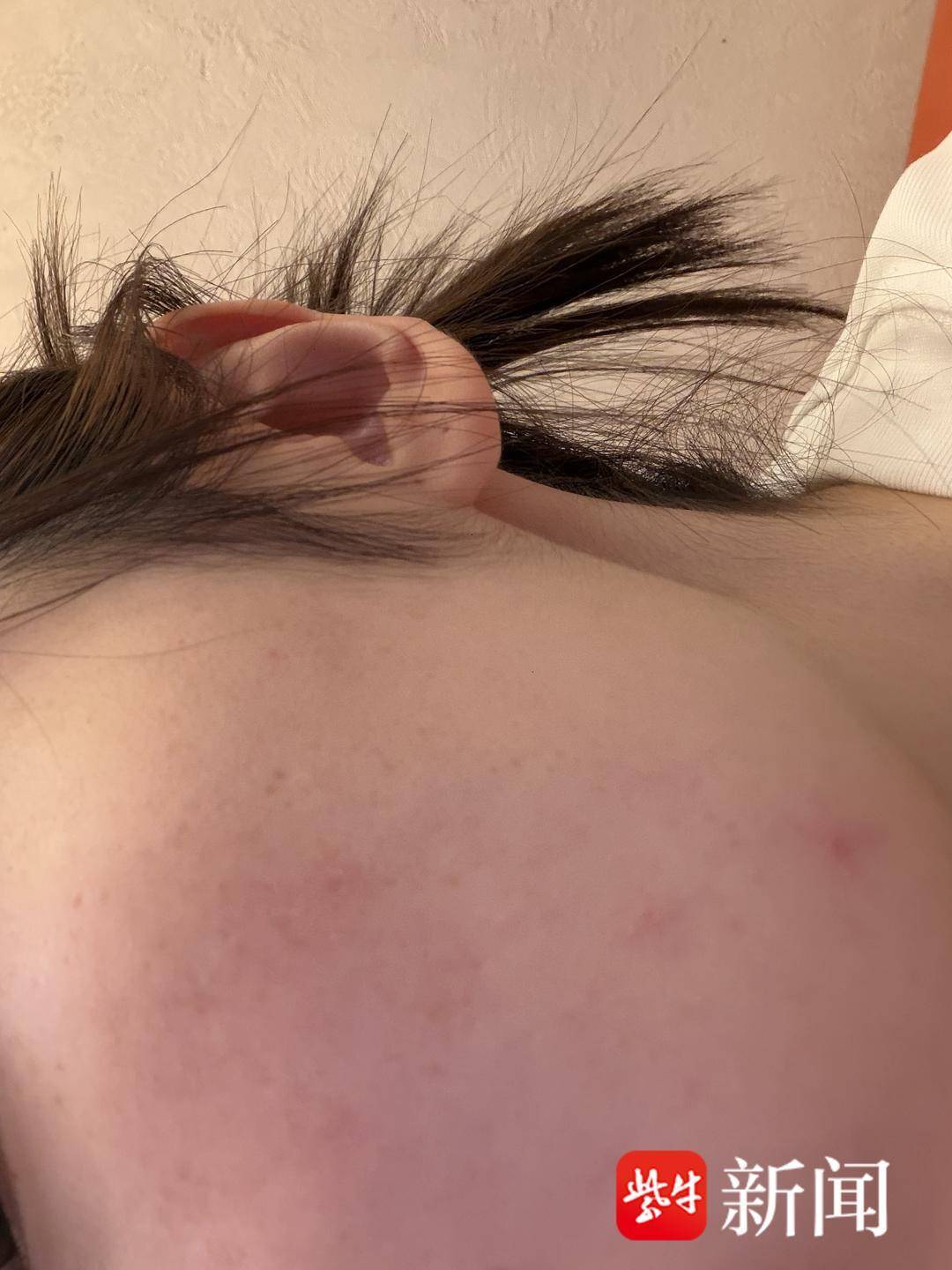 女子就餐时告知花生过敏仍被加花生油，商家垫付当日费用后拒赔