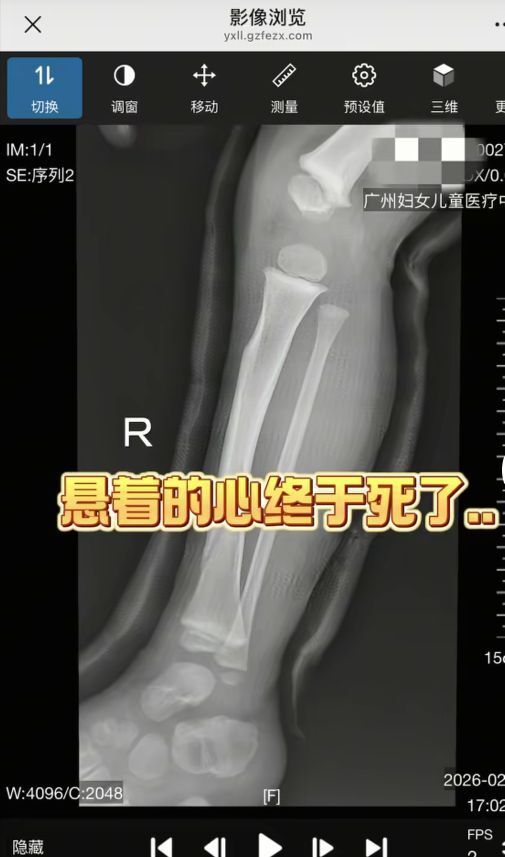 家长抱着孩子滑滑梯后孩子骨折，专家：千万不要用这种姿势带娃滑滑梯！