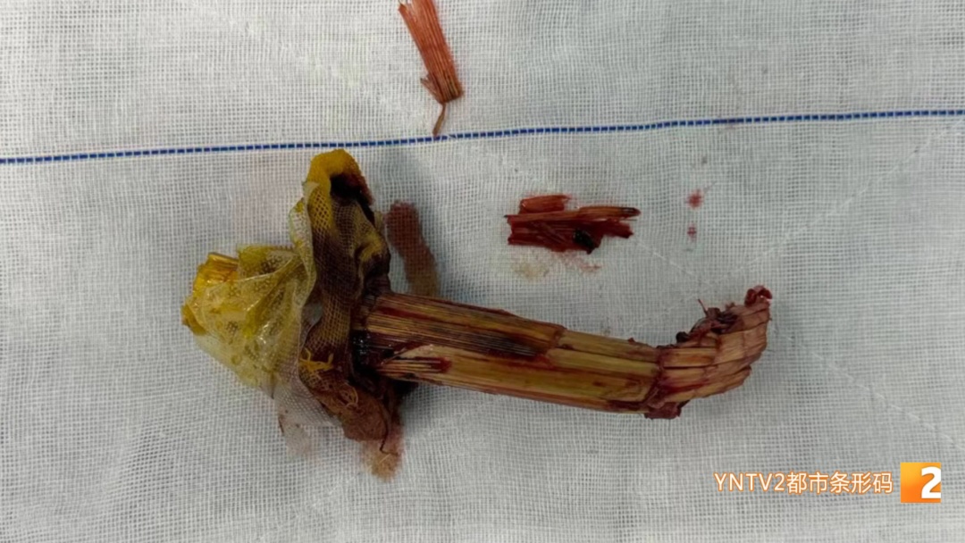 命悬一线!大理男子务农意外摔倒,玉米秆从耳后刺入7厘米,距颈动脉仅毫厘之差 命悬一线!大理男子务农意外摔倒,玉米秆从耳后刺入7厘米,距颈动脉仅毫厘之差