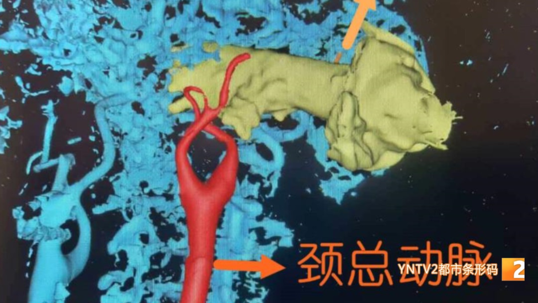 命悬一线!大理男子务农意外摔倒,玉米秆从耳后刺入7厘米,距颈动脉仅毫厘之差 命悬一线!大理男子务农意外摔倒,玉米秆从耳后刺入7厘米,距颈动脉仅毫厘之差