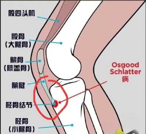 突击运动训练，膝盖下方长“鼓包”？专家提醒：这种疾病青少年高发
