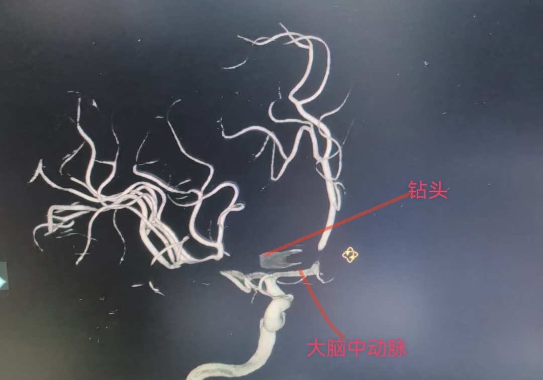 广东佛山一男子作业时 被除草机弹起的18厘米钢钻刺穿右眼 命悬一线