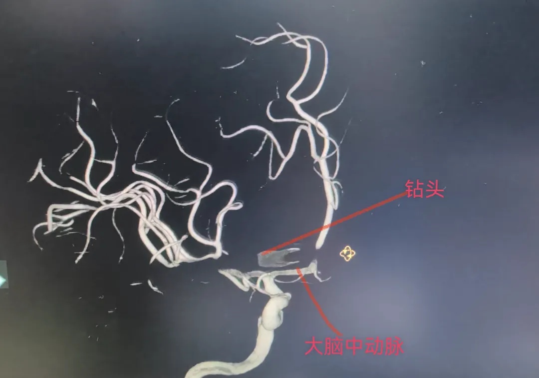 广东48岁男子除草时被18厘米钢钻从眼球处刺穿整个头颅,钢钻离大动脉仅数毫米 广东48岁男子除草时被18厘米钢钻从眼球处刺穿整个头颅,钢钻离大动脉仅数毫米