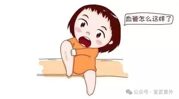 告别“蚯蚓腿”,运动来救场! 告别“蚯蚓腿”,运动来救场!