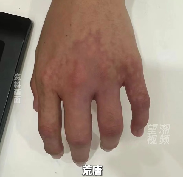 老板迷信“指缝宽易漏财”，到美容院给手指打玻尿酸，致整只手掌血管栓塞