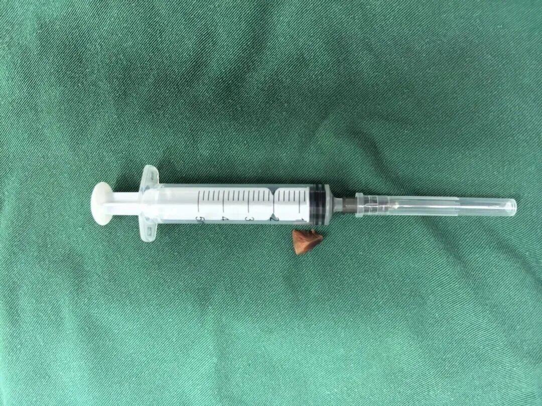 凌晨三点被疼醒!20岁小伙紧急就医,发现肠子破了一个洞! 凌晨三点被疼醒!20岁小伙紧急就医,发现肠子破了一个洞!