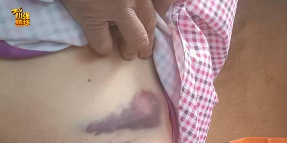 女子上班路上被大狼狗扑咬得血肉模糊！狗主人：赔3万？不可能！警方已介入