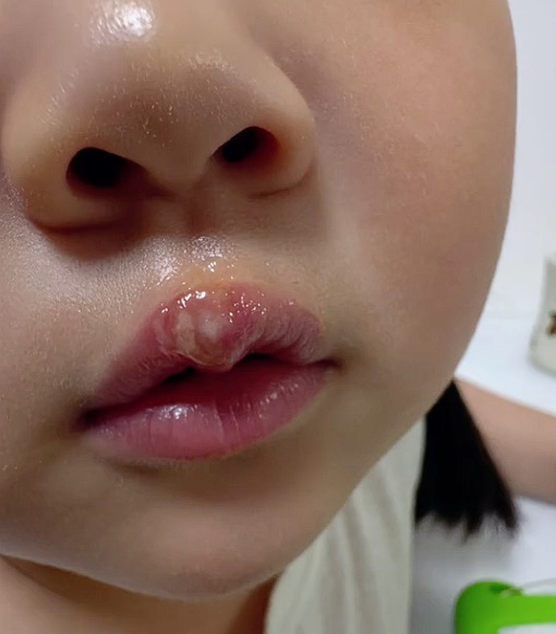 幼儿园老师,被指用热熔枪烫小女孩嘴唇 幼儿园老师,被指用热熔枪烫小女孩嘴唇