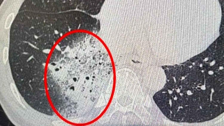 一觉醒来，女子高烧不退，肺白了大半！“凶手”出自这个电器，你可能天天在用！