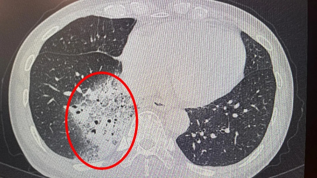 开了一晚上空调，女子肺白了大半！医生提醒：隐藏刺客不容忽视