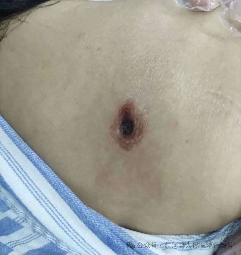 39岁网红博主被这种虫咬后不幸去世，症状很像感冒，严重可致命！