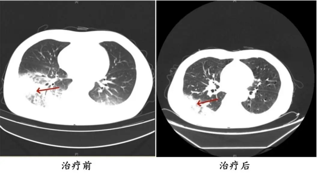 开了一晚上空调，女子肺白了大半！医生提醒：隐藏刺客不容忽视