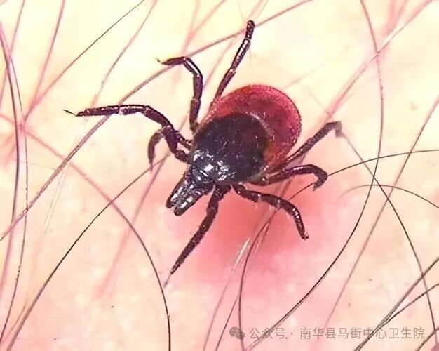 39岁网红博主被这种虫咬后不幸去世，症状很像感冒，严重可致命！