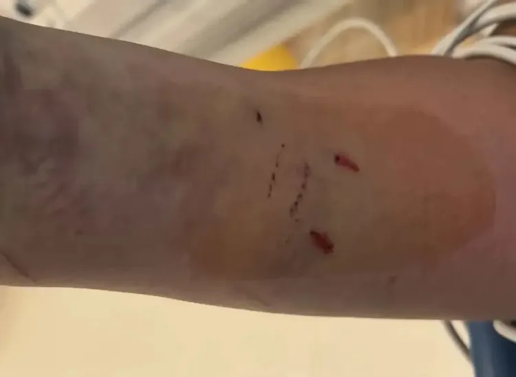 男子上山挖笋遭五步蛇突袭，右臂被咬伤，血小板跌至个位数，达危急值！医生提醒
