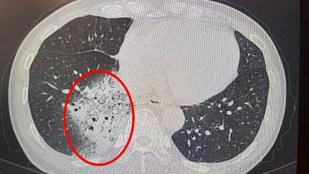 “吹一晚上空调,肺白了大半”?医生提醒:这个细节,很多人都忽视了 “吹一晚上空调,肺白了大半”?医生提醒:这个细节,很多人都忽视了