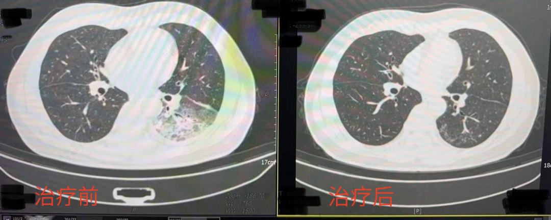 “吹一晚上空调,肺白了大半”?医生提醒:这个细节,很多人都忽视了 “吹一晚上空调,肺白了大半”?医生提醒:这个细节,很多人都忽视了